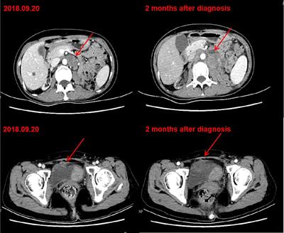 Nivolumab for Metastatic Urothelial Cancer in a Renal Allograft Recipient With Subsequent Graft Rejection and Treatment Complete Remission: A Case Report